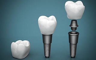 Dental Implants | West Ryde Dental Clinic