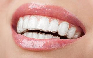 Invisalign | West Ryde Dental Clinic