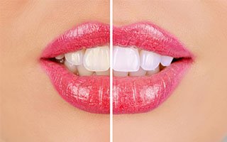 Teeth Whitening | West Ryde Dental Clinic